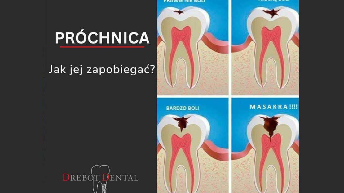 Zapobieganie Próchnicy Kluczowe Kroki dla Zdrowych Zębów