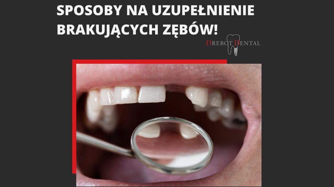 Sposoby na uzupełnienie brakujących zębów