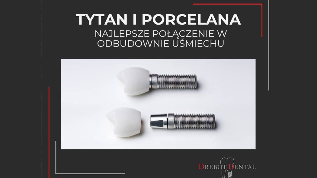 Tytan i Porcelana: najlepsze połączenie w odbudowie uśmiechu