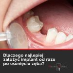 Dlaczego warto założyć implant od razu po usunięciu zęba?