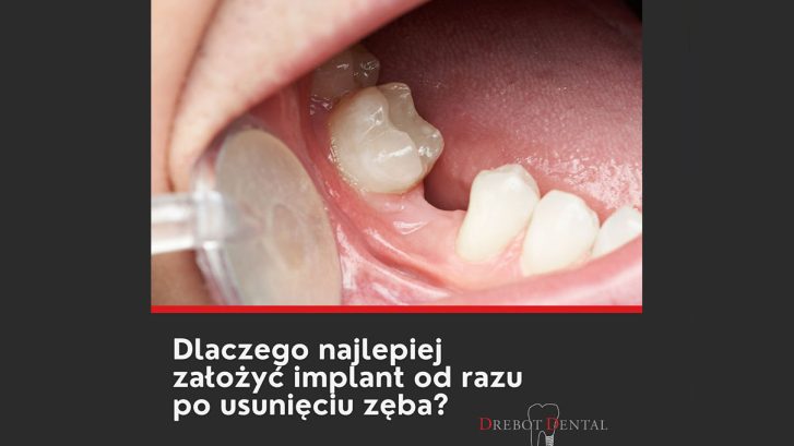 Dlaczego warto założyć implant od razu po usunięciu zęba?