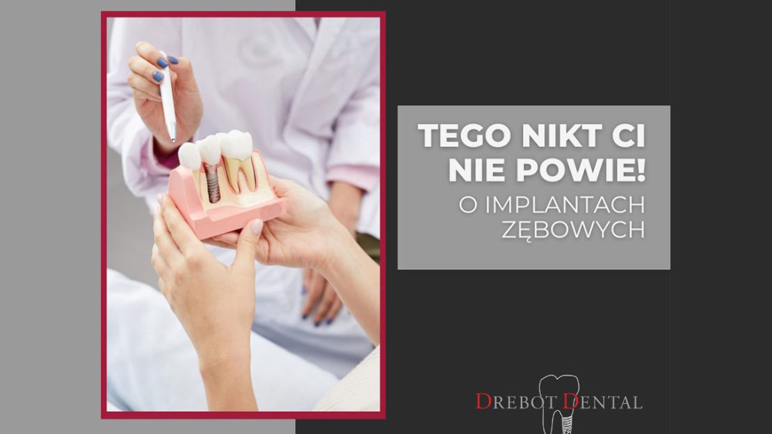 Tego nikt Ci nie powie o implantach zębowych