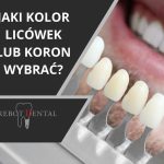 Jaki kolor licówek albo koron wybrać