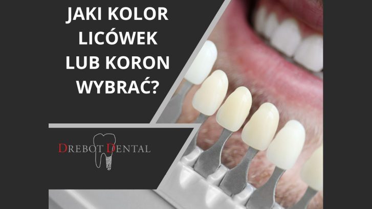 Jaki kolor licówek albo koron wybrać