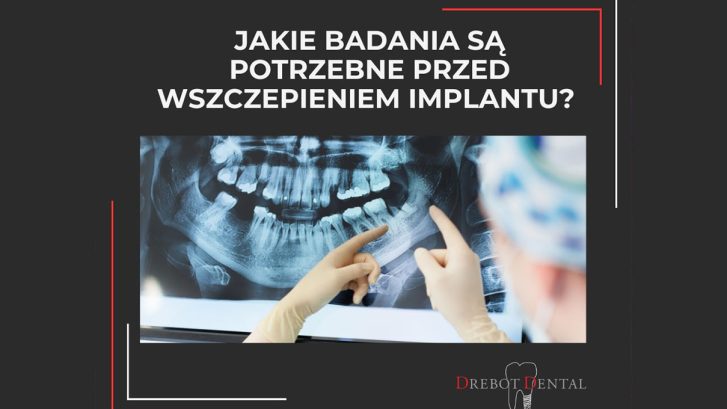 Jakie badania są potrzebne przed wszczepieniem implantu zębowego?