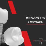 Implanty w liczbach – ciekawostki, które warto znać