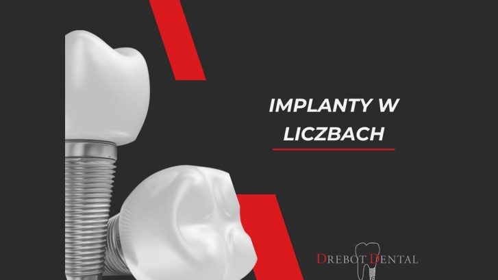 Implanty w liczbach – ciekawostki, które warto znać