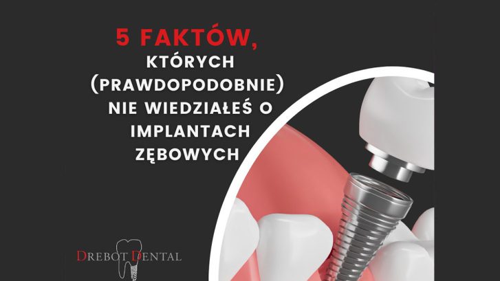 5 faktów, których nie wiedziałeś o implantach zębowych