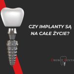 Czy implanty są na całe życie?