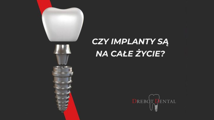 Czy implanty są na całe życie?